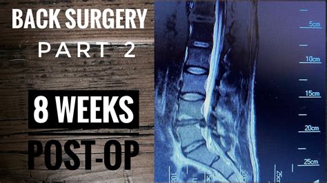 Overcoming the Pain and Struggles of Recovering From L3 L4 Fusion Surgery